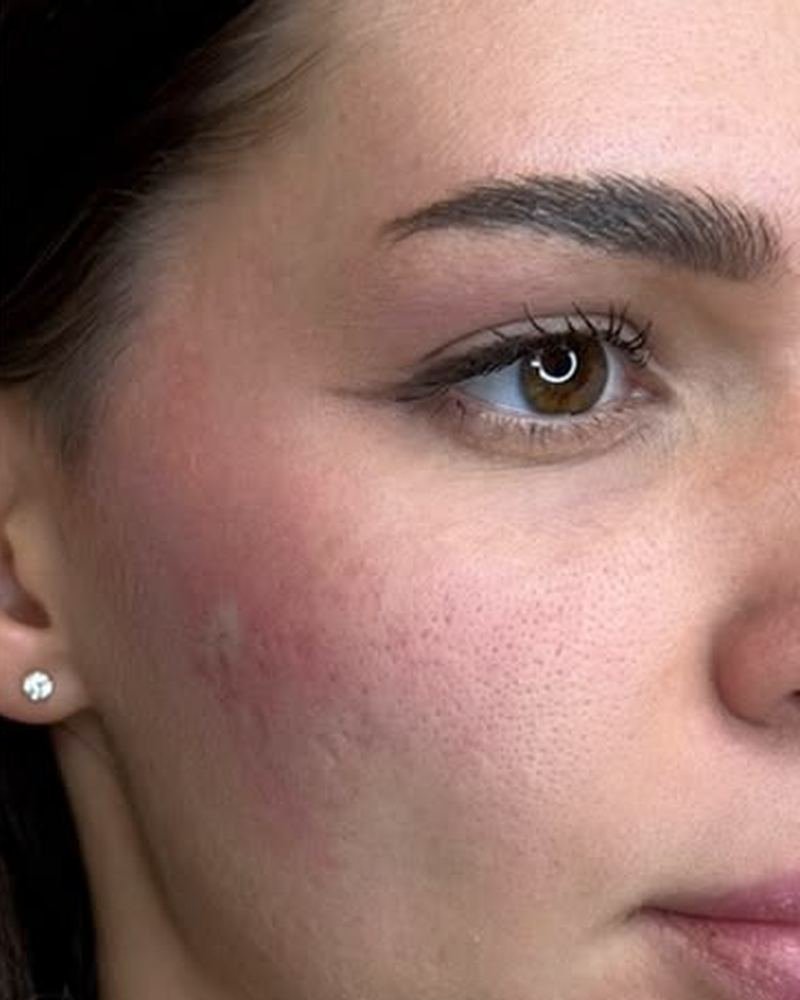 Cheek filler after, ZK client