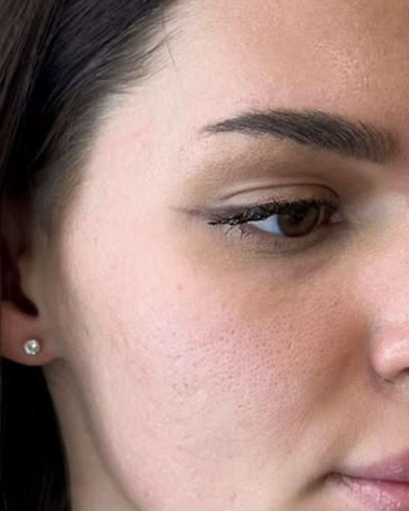 Cheek filler before, ZK client