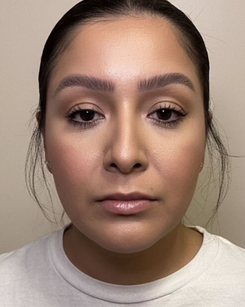 Lip filler before, ZK client