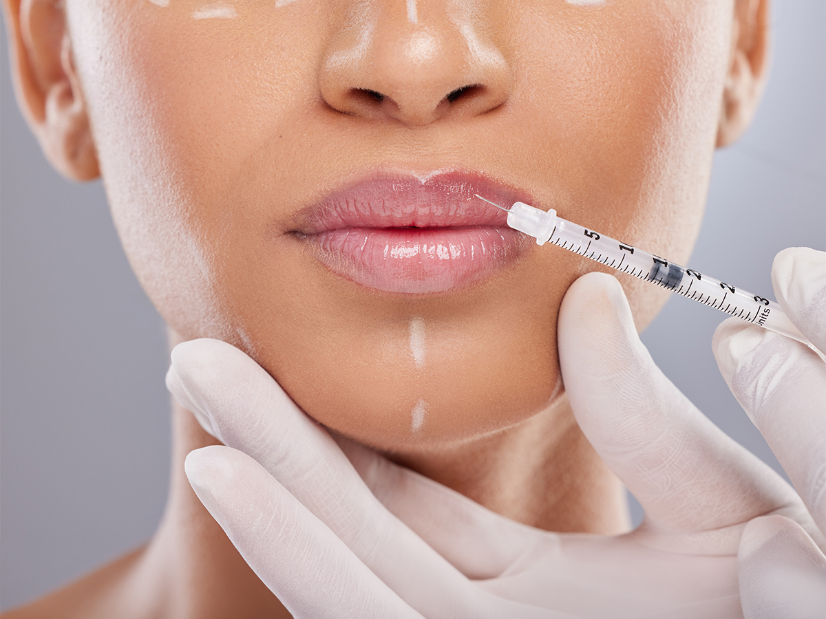 Lip filler before and after results at ZK Aesthetics Sacramento