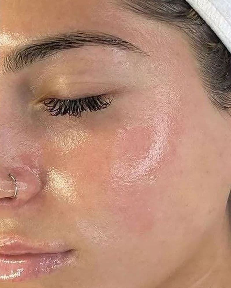 Microneedling after, ZK client