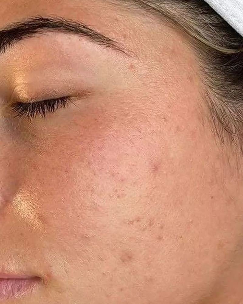 Microneedling before, ZK client